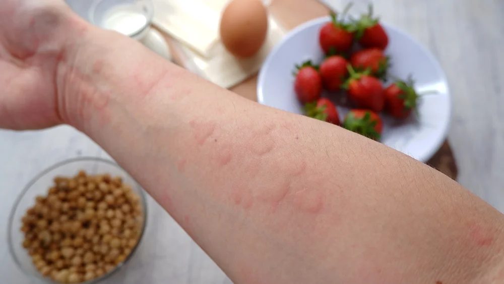Allergies and What to Eat for Allergies | Everything You Need to Know